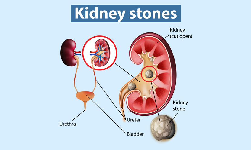 ABCD of Kidney Stones