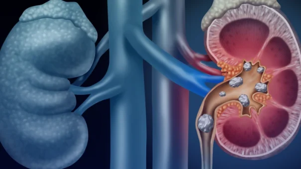 ABCD of Kidney Stones