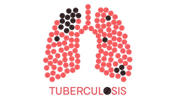 All you need to Know about Tuberculosis