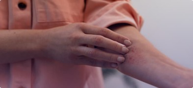 Fungal Infection vs Eczema: How to Tell the Difference