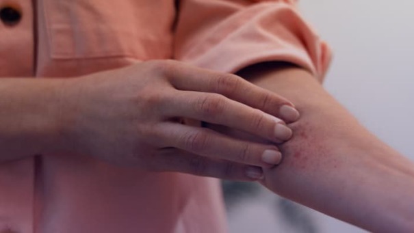Fungal Infection vs Eczema: How to Tell the Difference