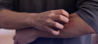 How to Treat Ringworm at Home: A Step-by-Step Guide